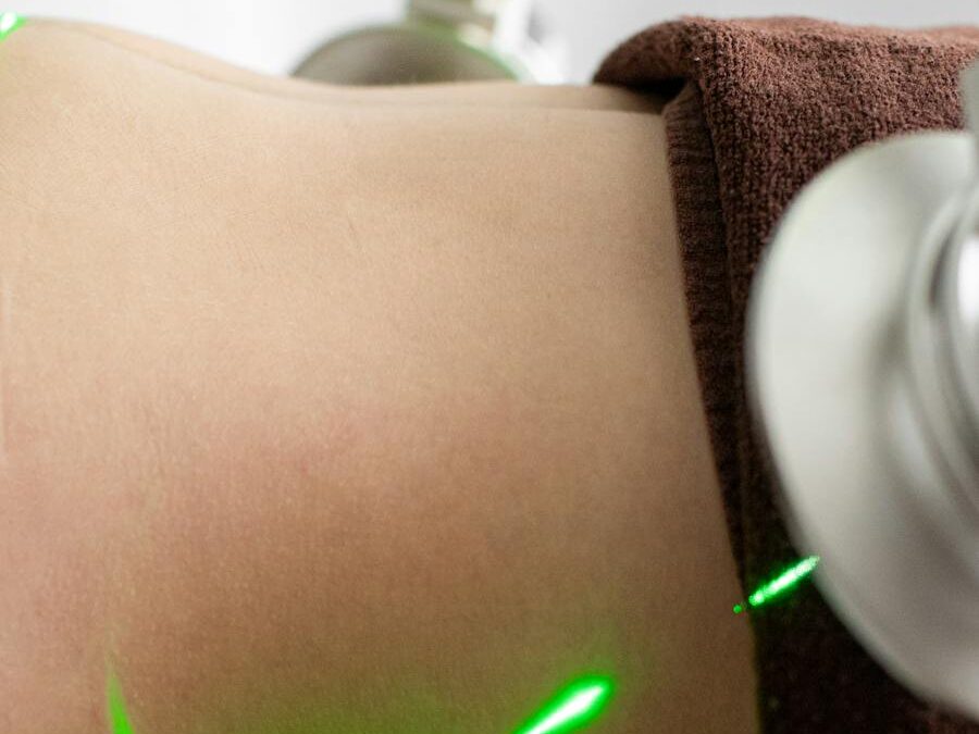 Cisto Pilonidal: Descubra como o Tratamento com Laser Pode Fazer