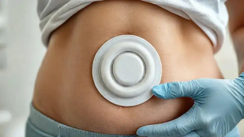 Estoma: tipos, cuidados essenciais e como evitar complicações