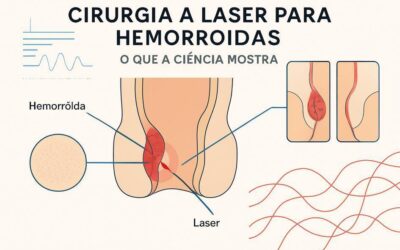Cirurgia a laser para hemorroidas