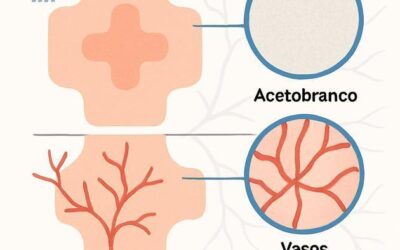O que dá para ver na anuscopia de magnificação (acetobranco, vasos, padrões);